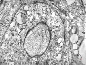 M,2y. | myopathy - regenerating muscle cell